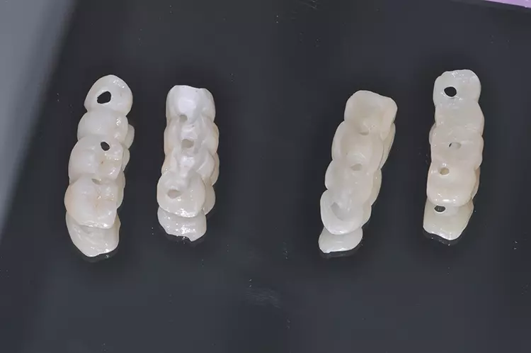 Abb. 10: Gefräste Schalenverblendung in PMMA
und Keramik.