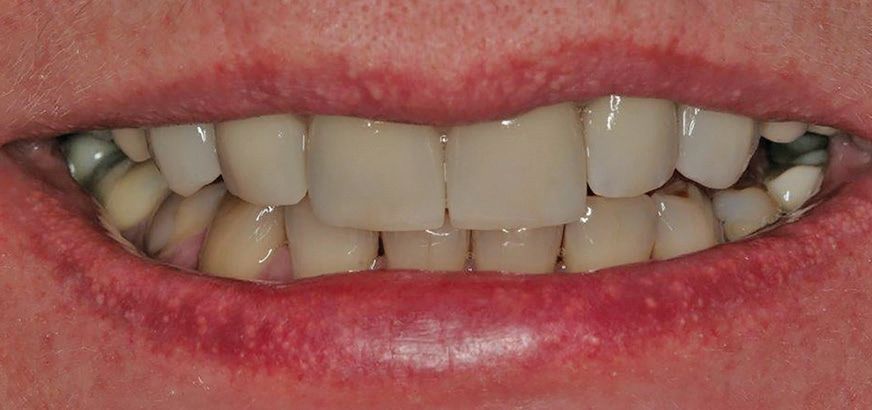 Abb. 7c: Begutachtung der Rohbrandeinprobe im Patientenmund.