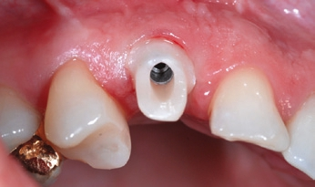 Abb. 10: Individuelles Zirkonoxid-Abutment.