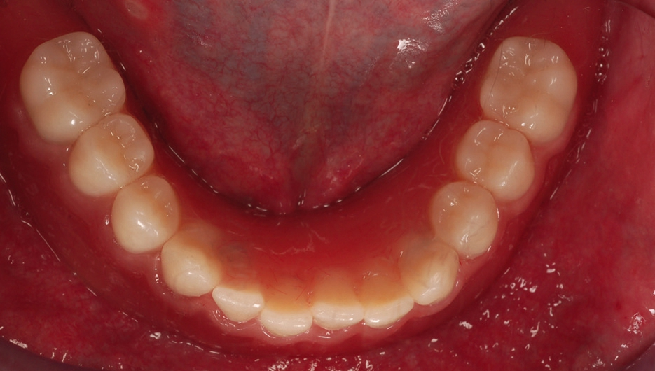 Abb. 11: Auf Kugelkopfankern befestigte Cover denture-Prothese in situ.