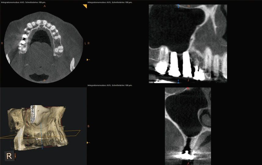 Abb. 5b: Darstellung von zwei Implantaten regio 16 und 15 zur Periimplantitis-Diagnostik. Axial, coronal und sagittal. Keine Beurteilung durch Burn-out-Effekt.