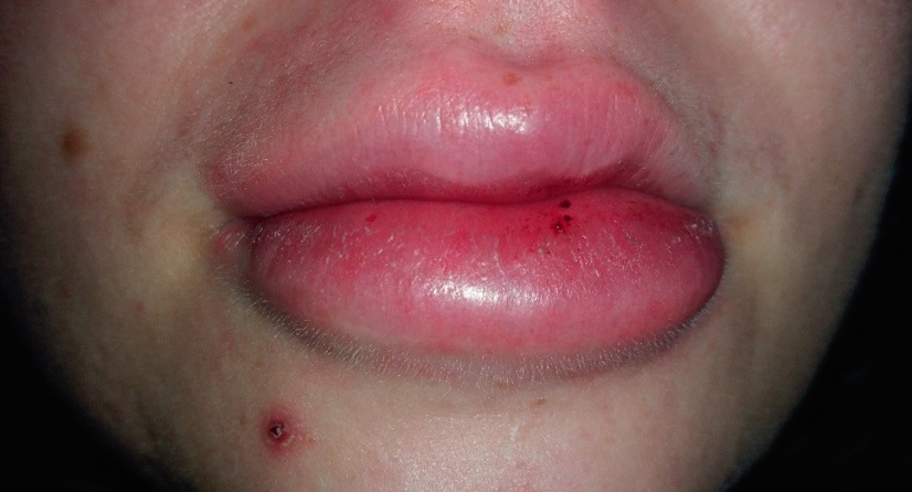 Abb. 9: Ausgeprägtes Angioödem der Lippen als Reaktion auf die Einnahme von Ibuprofen.