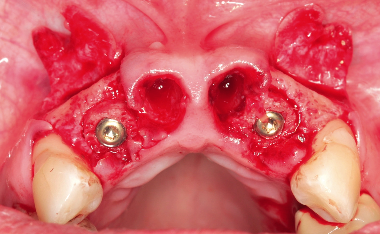 Abb. 9: Implantation von zwei Knochenringen und zwei Straumann BLT Implantaten ø 3,3 mm 10 mm (Zähne 21 und 22).