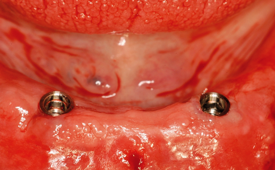 Abb. 10: Die Implantate sollten nach Abnahme der Schablone bündig oder ca. 0,5 mm subgingival sitzen.