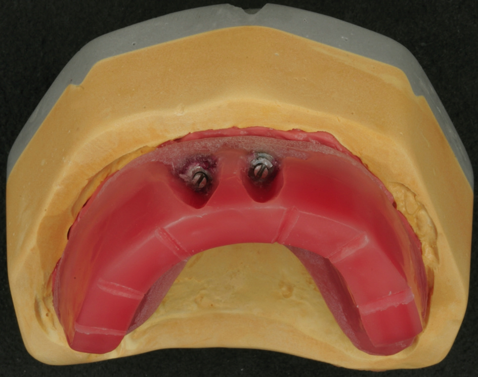 Abb. 10: Wachswall auf dem Meistermodell; in Regio 11 und 21 ist der Wachswall mithilfe von gekürzten Abformpfosten auf den Implantaten fixiert.