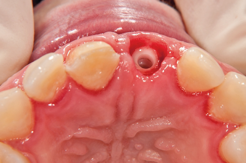 Abb. 10: Nach Entnahme des Gingivaformers.