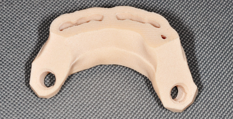 Abb. 10: Erste Schablone (ohne Bohrhülsen) zum Setzen der distalen 35° abgewinkelten Implantate.