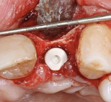 Abb. 10: Eine optimale Implantatposition für die Rekonstruktion mit einer direkt verschraubten Hybridabutmentkrone. Die Darstellung zeigt das ausgeprägte bukkale Knochendefizit.
