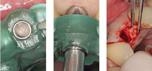 Abb. 10a-c: Freilegung der Bohrstelle mittels Gewebestanze (BEGO Guide Tissue punch) mit der Bohrschablone in situ.