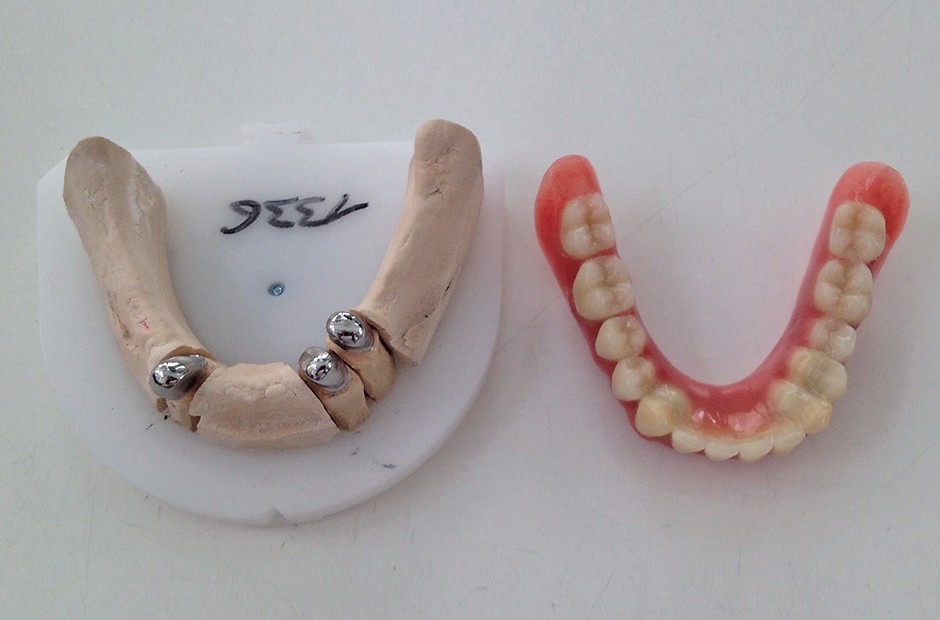 Abb. 9b: Neue UK-Teleskope mit Cover-Denture-Prothese.