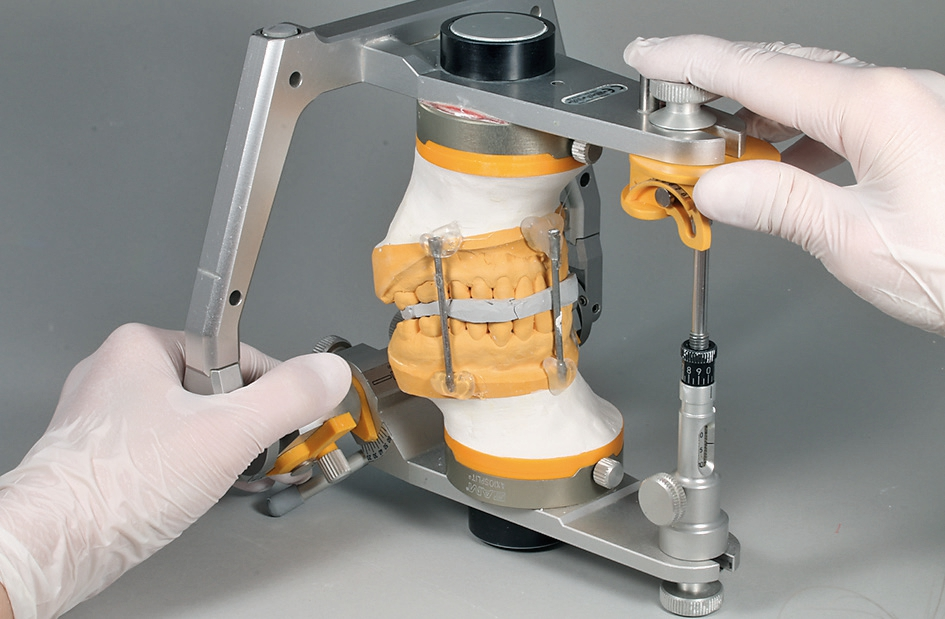 Abb. 23: Mit dem Protrusionsregistrat verschlüsselte Modelle, nachjustierter Stützstift.