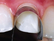 Abb. 10: Zirkulär um den Zahn geschlungener Metallstreifen als Gingivaschutz für die Abstrahlung mit Aluminiumoxid.