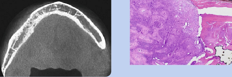 Abb. 15 u. 16: Axiale Ansicht ROI, DVT, histologischer Befund.