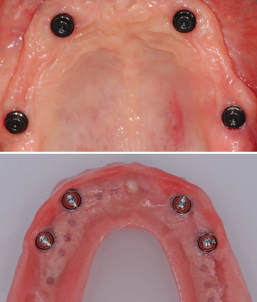 Abb. 10a u. b: Abnehmbare gaumenfreie Versorgung mit Novaloc (Straumann) bei zu geringem Platzangebot für eine primäre Verblockung. Hier sind mindestens vier Implantate angezeigt.