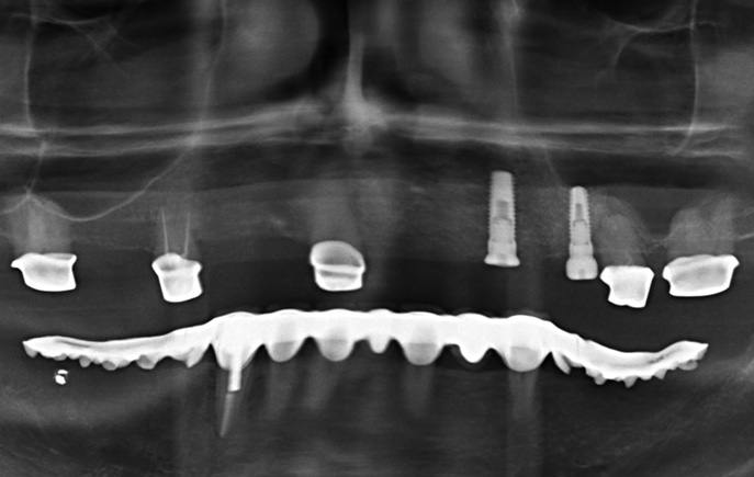 Abb. 47: Röntgenkontrolle nach Implantation.