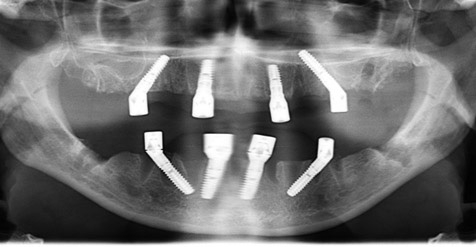 Abb. 12: Röntgenkontrollaufnahme mit den vorübergehend eingesetzten Gingivaformern.