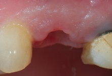 Abb. 10: Stabile gingivale Verhältnisse nach der zehntägigen Einheilphase.