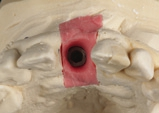 Abb. 12: Zahnfleischmaske mit Durchtrittsprofil auf Meistermodell.
