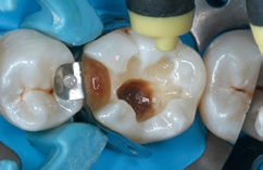 Abb. 10: Vorsichtiges Verblasen des Lösungsmittels aus dem Adhäsivsystem.