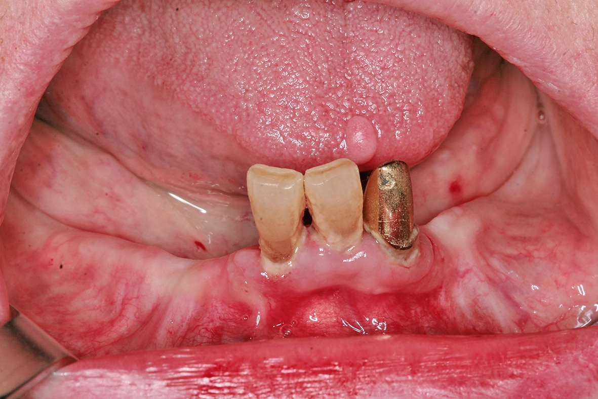 Abb. 10: Ausganssituation. Die Restbezahnung sollte erhalten bleiben und der vorhandene Zahnersatz mit Implantaten stabilisiert werden.