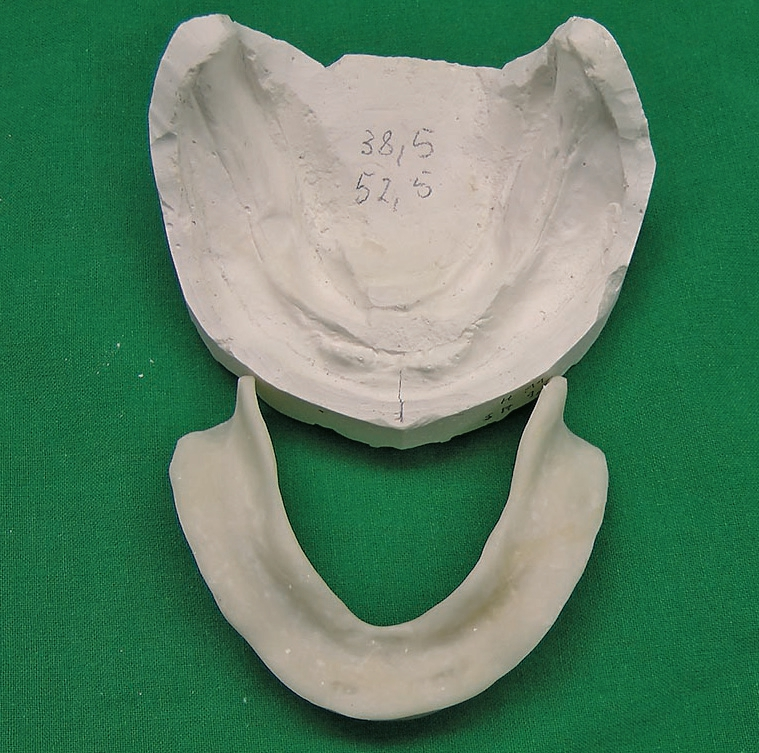 Abb. 5: Unterkiefermodell mit zugehörigem individuellem Löffel ...