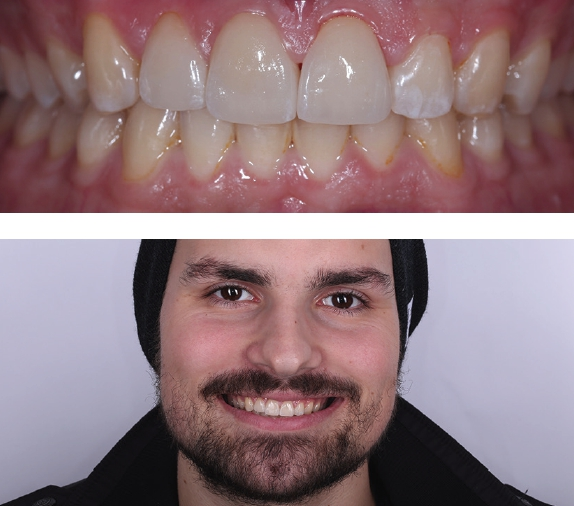 Abb. 12 u. 13: Schlussbisssituation nach Eingliederung der vollkeramischen Restaurationen und ein strahlender Sportler.