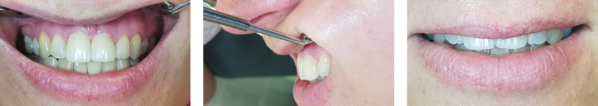 Abb. 11–13: Das Endergebnis nach der Eingliederung bei der Patientin.