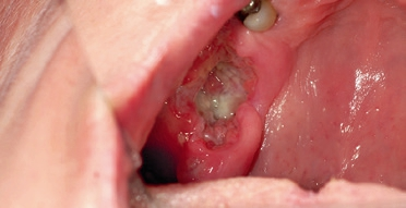 Abb. 10: Plattenepithelkarzinom Rg. 16, zunächst klinisch eine nicht heilende Extraktionsalveole.