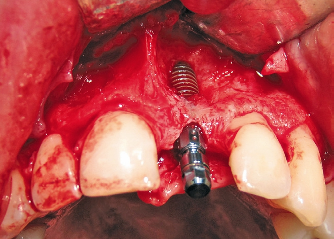 Abb. 8: Implantat in situ, Austrittwinkel von vestibulär.