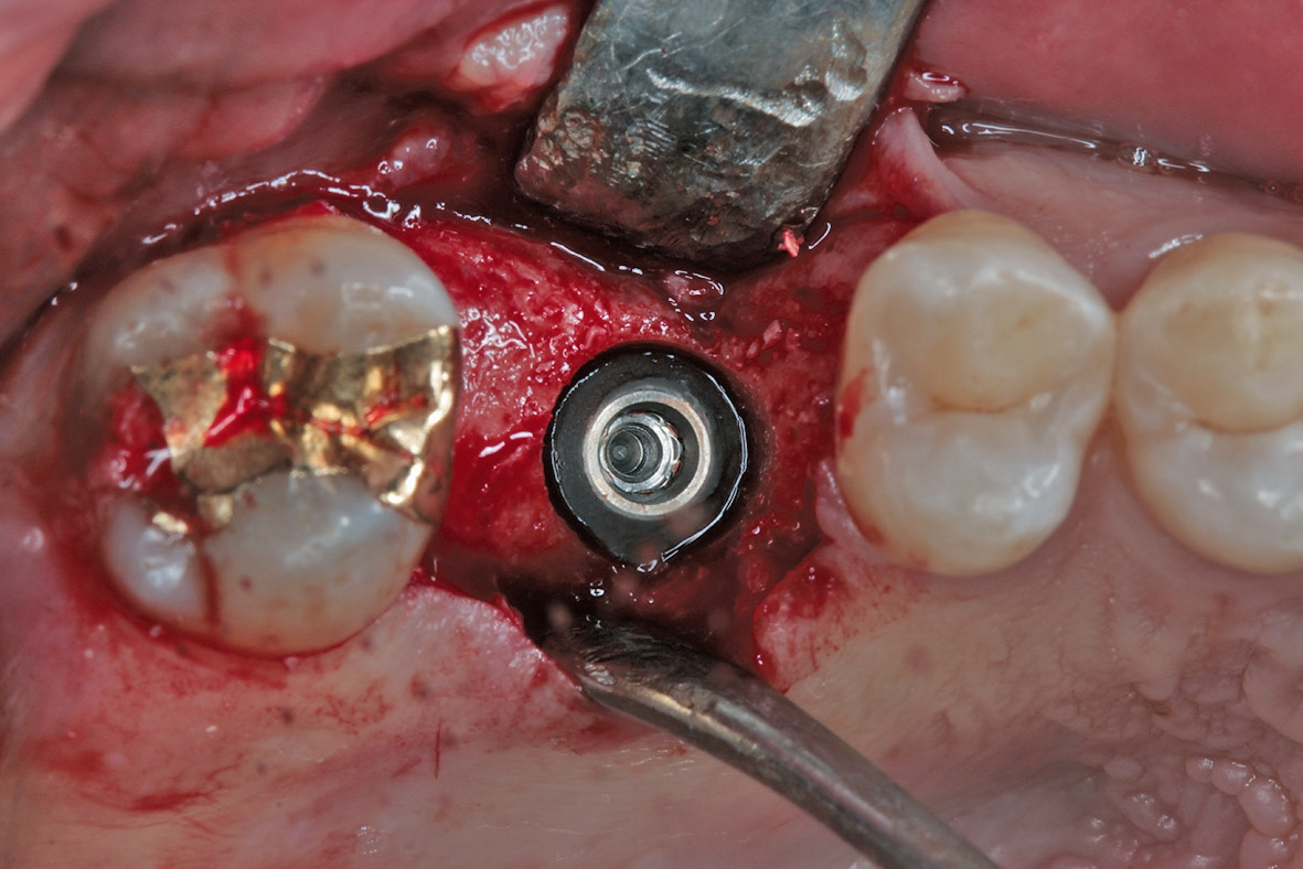 Abb. 10: Vestibulär leicht subcrestale Positionierung des kurzen Implantates (copaSKY, D5 L5,2 mm, bredent medical, Senden).