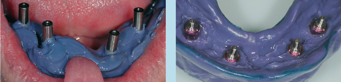 Abb. 9 u. 10: Offene Abformung in situ und nach Entnahme (Cave: Schrauben vor Entnahme des Löffels aus Implantatinnenverbindung lösen und herausziehen!