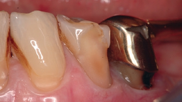 Abb. 10: Anderer klinischer Fall im Detail betrachtet. Auch hier ist die schadhafte Aufsummierung zweier die Zahnhartsubstanz abtragender Effekte klar ersichtlich. Die gleichen wie in Abbildung 9?