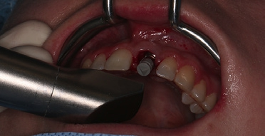 Abb. 9: CEREC Scan intraoperativ mit Scanpost/Scanbody.