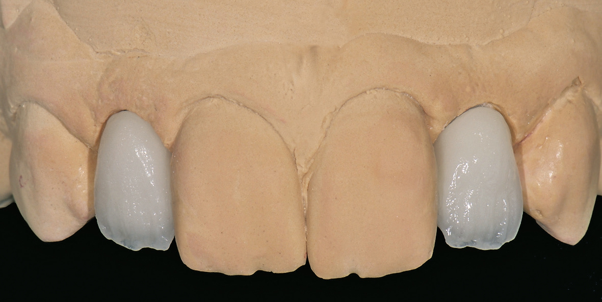 Abb. 10: Ergebnis nach dem ersten Dentinbrand.