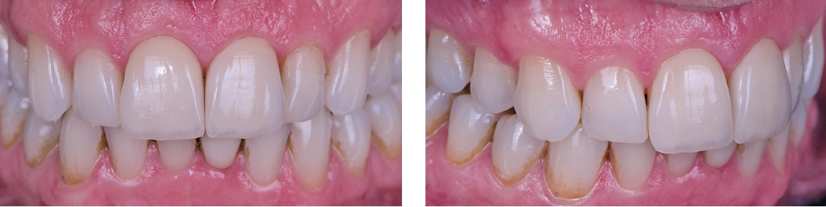 Abb. 11 u. 12: Veneers auf den Zähnen 11 und 21. Der Helligkeitswert der benachbarten Zähne ist exakt wiedergegeben. Es zeigt sich eine natürliche Tiefenwirkung bei minimaler Schichtstärke.