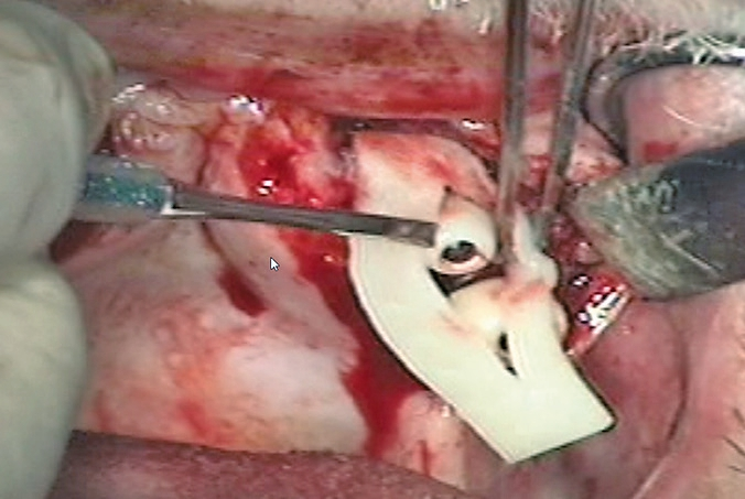 Abb. 14: Bild aus OP-Video: Membran und palatinaler Split-flap mit vestibulärem Stauchungslappen.