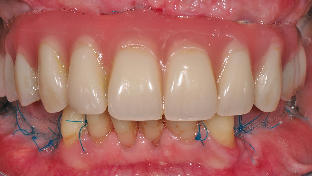 Abb. 10: Oberkieferprothese nach Operation eingeschraubt mit 10 Ncm.