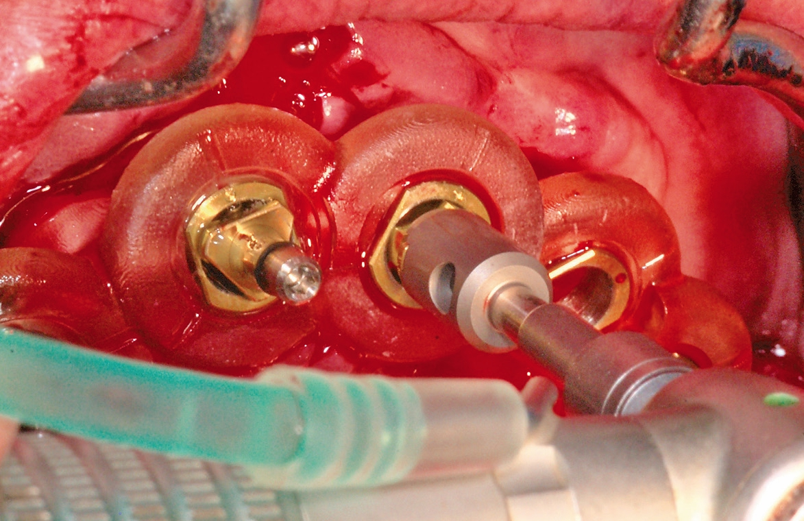 Abb. 10: Full guided Insertion der Implantate durch die Schablone.