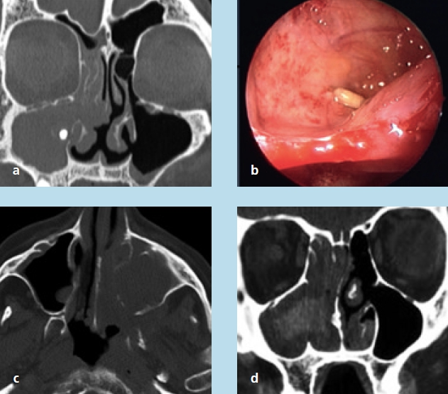 Abb. 8a–d: a) Pansinusitis rechts mit Nachweis eines Fremdkörpers in der rechten Kieferhöhle. b) Endoskopischer Einblick nach Entfernung der entzündlichen Sekrete. c) Totalverschattung der linken Kieferhöhle bei Metastasen eines Mammakarzinoms. d) Pansinusitis bei fungaler Sinusitis.