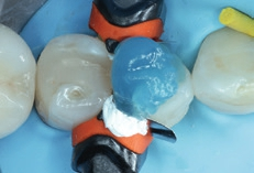 Abb. 10: Ätzen der Zahnoberfläche mit Phosphorsäuregel. Die Einwirkzeit auf Dentin sollte maximal 15 Sek. betragen, um ein Überätzen zu vermeiden.