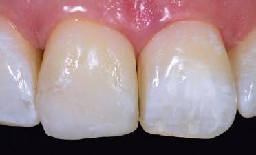 Abb. 10: Es wurde ein einfarbiges opakes Material (Venus Diamond, OMC, Kulzer) benutzt. Wesentliches Augenmerk wurde vorerst auf die Form und Gestaltung des distalen Aufbaus gelegt. Die Konturmerkmale wurden spiegelbildlich ausgearbeitet und eine weitgehend monochromatische Füllung aufgebaut.