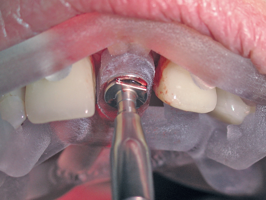 Abb. 8: Osteotomiebohrer mit apikalem Stopp und abgefl achten Seiten für die Kühlung.