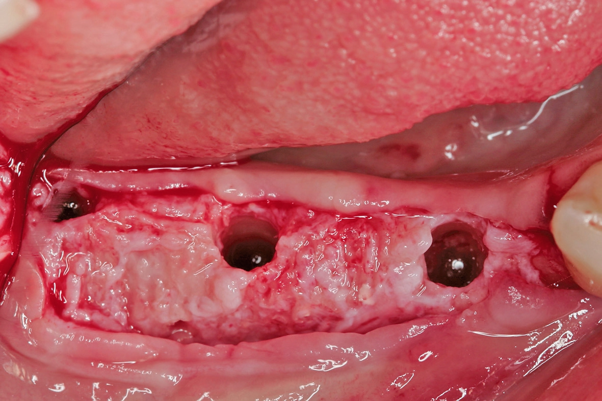 Abb. 12: Optimale Implantatpositionierung.