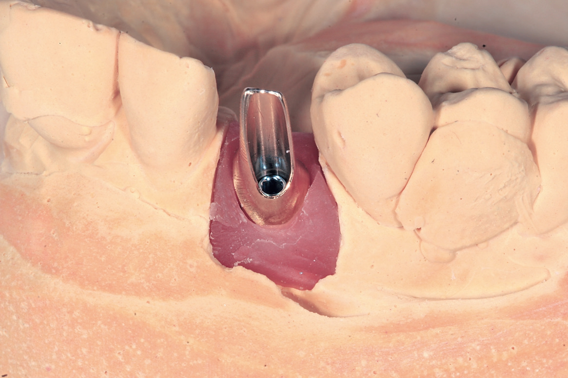 Abb. 10: Patientenspezifisches ATLANTIS-Abutment aus goldfarbenem Titan.