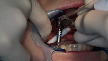 Abb. 10: Einbringen des Implantats durch die Hülse mit Höhenanschlag.