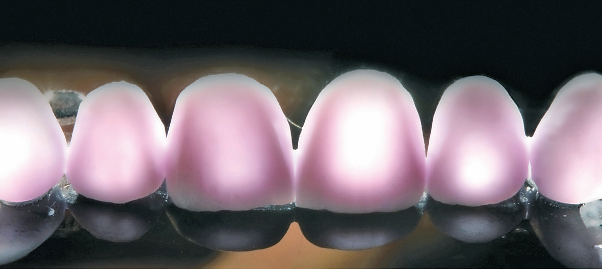 Abb. 9: Das Bild der Restaurationen im Durchlicht vor der Kristallisation (blauer Zustand) zeigt die unterschiedlichen Schichtstärken.