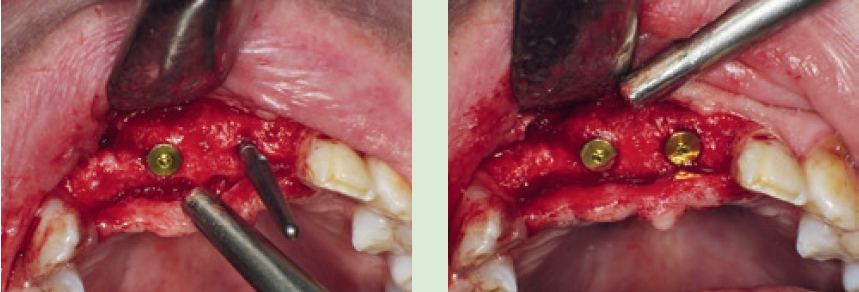 Abb. 10a u. b: Implantation in stabiles Knochengewebe – anders als zuvor geplant – regio 11 und 21.
