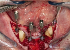 Abb. 10: Implantate mit Screw-retained-Abutments (SRA) versorgt, Einbringhilfen zum Ausrichten der prothetischen Achsen.