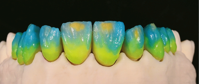 Abb. 12: Applikation von Transpa Dentin-, Transpa Incisal- und Transpa-Impulsmassen für den Korrekturbrand.