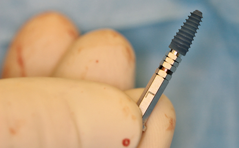 Abb. 10: Das Implantat der Wahl: Megagen Any Ridge.